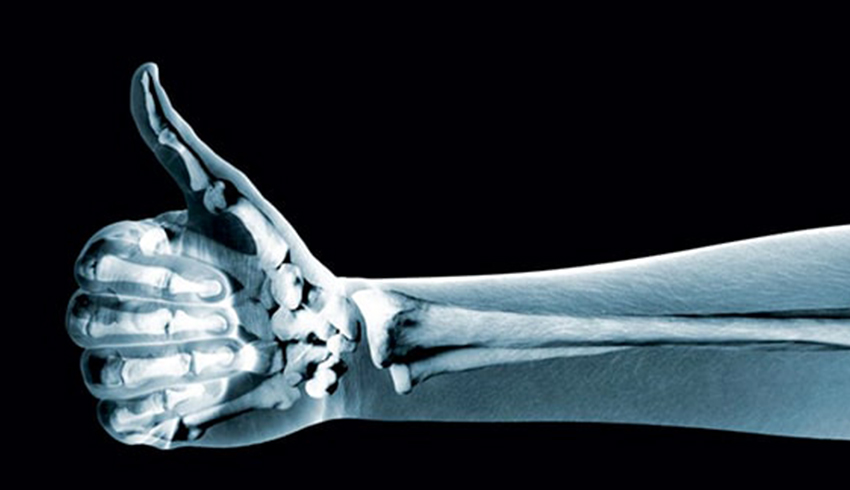 Checklist of Diseases That Cause Bone Loss